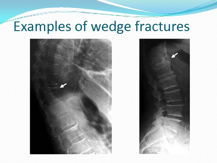 Examples of wedge fractures 