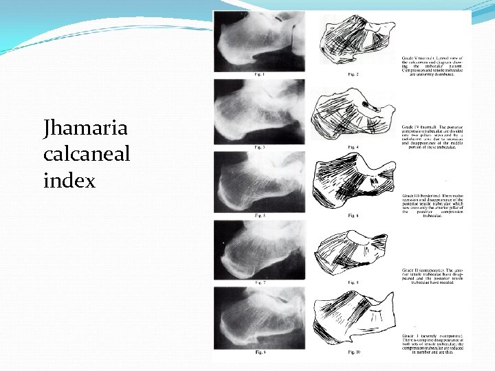 Jhamaria calcaneal index 