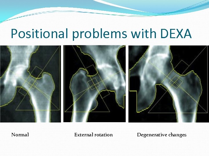 Positional problems with DEXA Normal External rotation Degenerative changes 