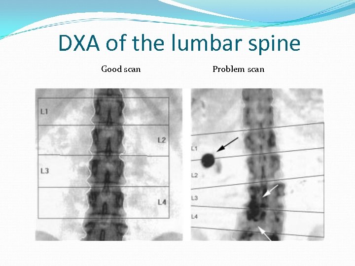 DXA of the lumbar spine Good scan Problem scan 