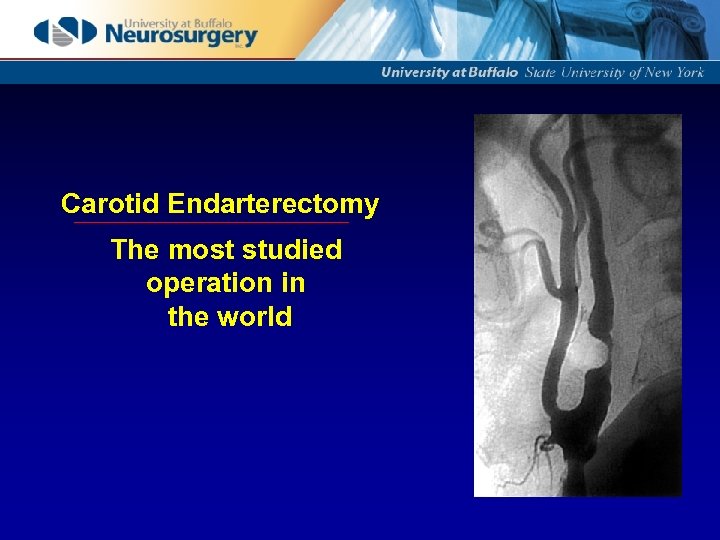 Carotid Endarterectomy The most studied operation in the world 