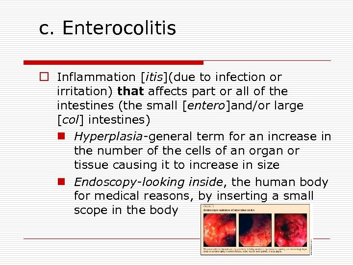 c. Enterocolitis o Inflammation [itis](due to infection or irritation) that affects part or all