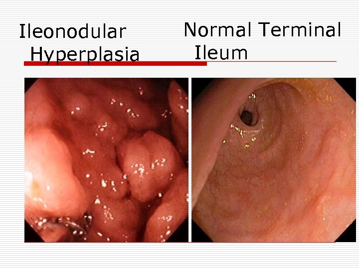 Ileonodular Hyperplasia Normal Terminal Ileum 