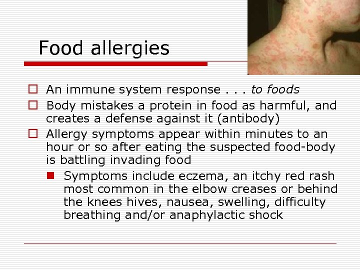 Food allergies o An immune system response. . . to foods o Body mistakes