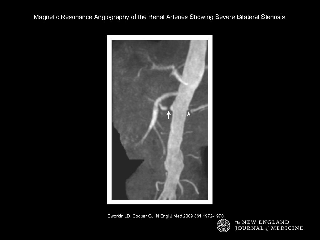 Magnetic Resonance Angiography of the Renal Arteries Showing Severe Bilateral Stenosis. Dworkin LD, Cooper
