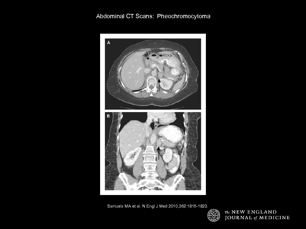 Abdominal CT Scans: Pheochromocytoma Samuels MA et al. N Engl J Med 2010; 362: