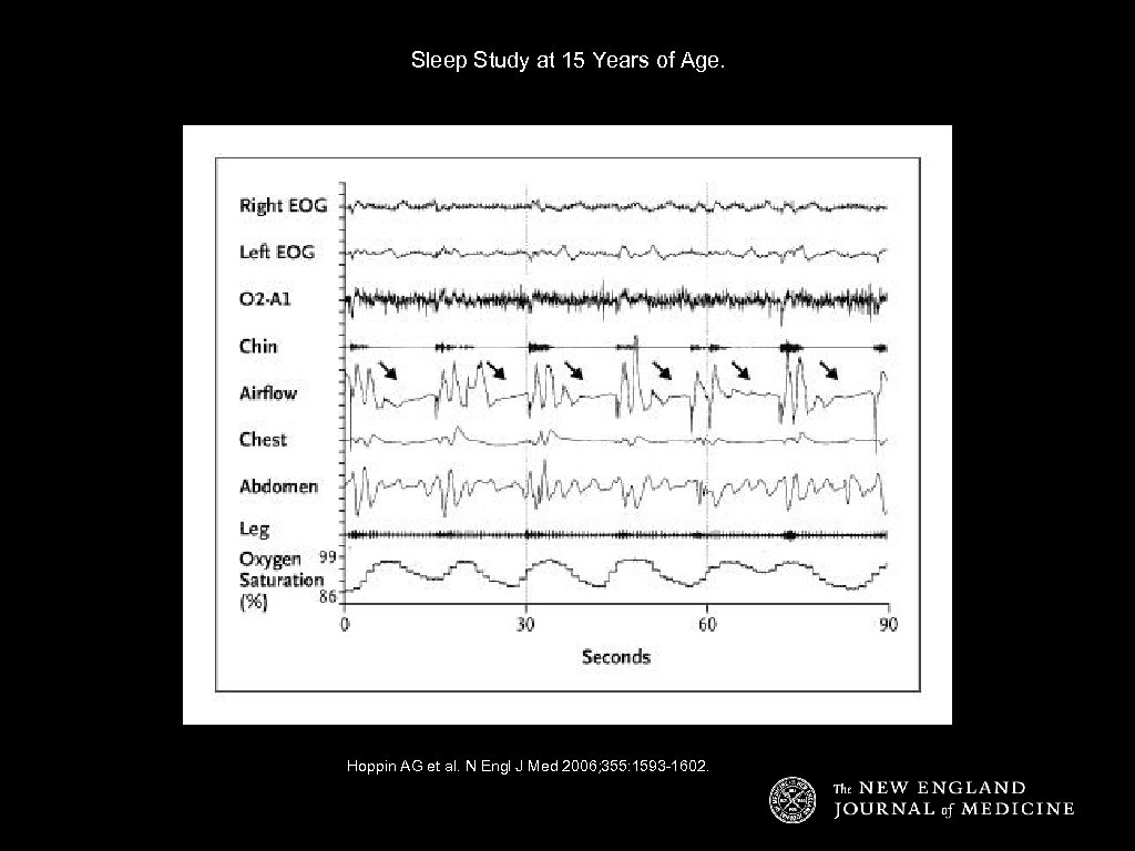 Sleep Study at 15 Years of Age. Hoppin AG et al. N Engl J