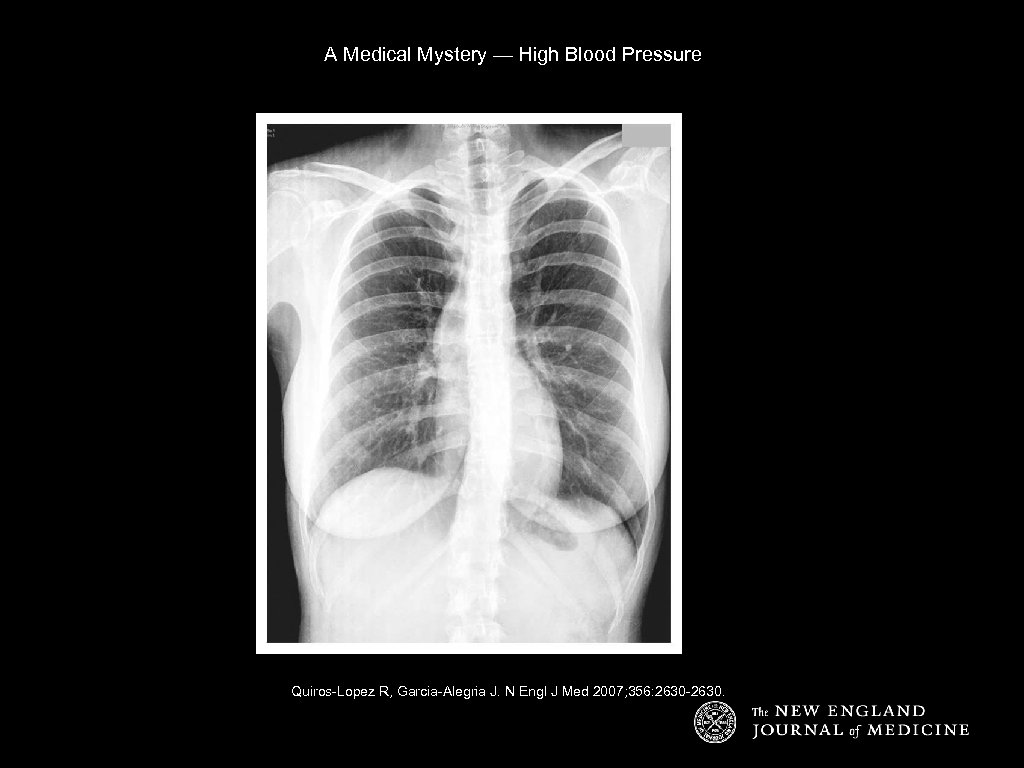 A Medical Mystery — High Blood Pressure Quiros-Lopez R, Garcia-Alegria J. N Engl J