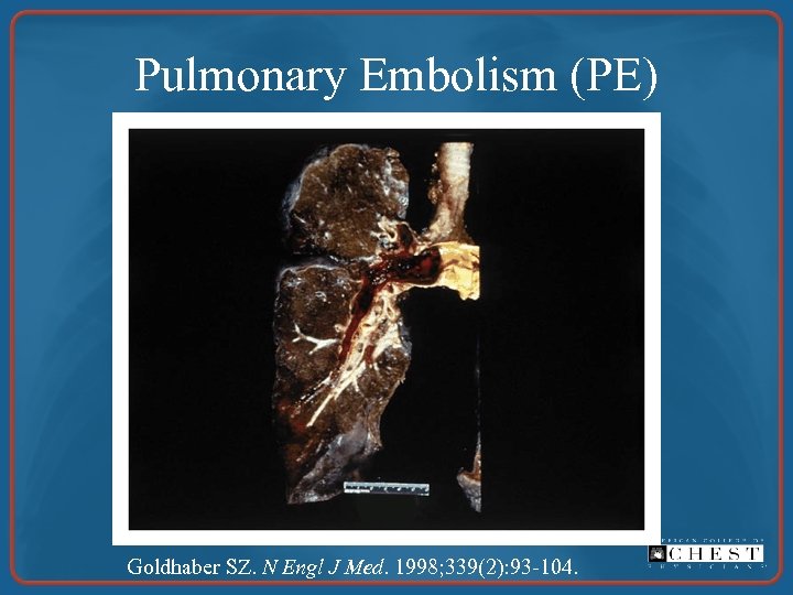 Pulmonary Embolism (PE) Goldhaber SZ. N Engl J Med. 1998; 339(2): 93 -104. 