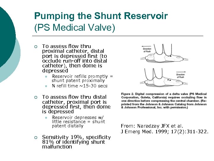 Pumping the Shunt Reservoir (PS Medical Valve) ¡ To assess flow thru proximal catheter,