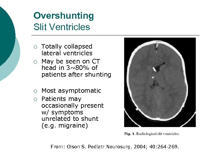 Overshunting Slit Ventricles ¡ ¡ Totally collapsed lateral ventricles May be seen on CT