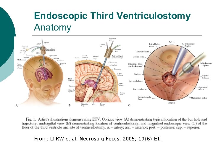 Endoscopic Third Ventriculostomy Anatomy From: Li KW et al. Neurosurg Focus. 2005; 19(6): E