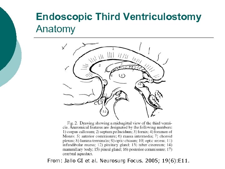 Endoscopic Third Ventriculostomy Anatomy From: Jallo GI et al. Neurosurg Focus. 2005; 19(6): E