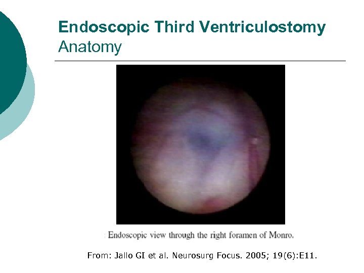 Endoscopic Third Ventriculostomy Anatomy From: Jallo GI et al. Neurosurg Focus. 2005; 19(6): E