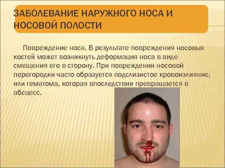 ЗАБОЛЕВАНИЕ НАРУЖНОГО НОСА И НОСОВОЙ ПОЛОСТИ Повреждение носа. В результате повреждения носовых костей может