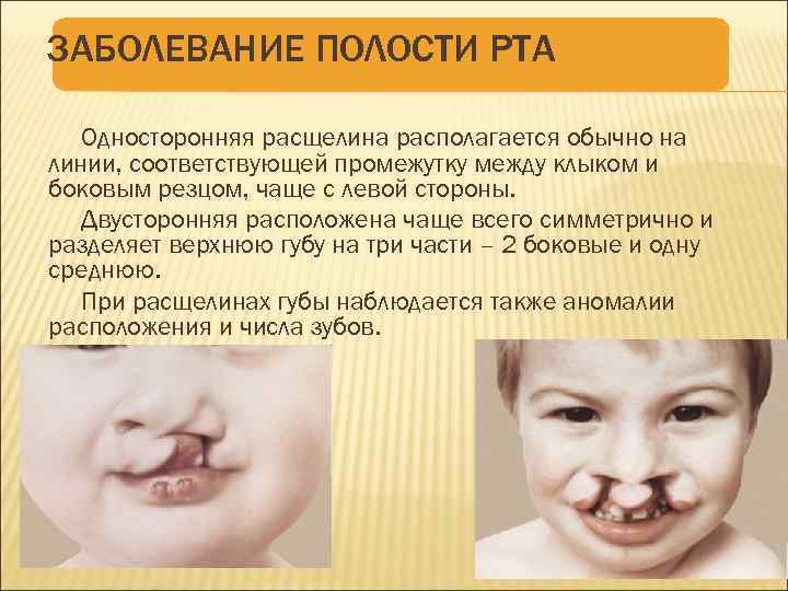 ЗАБОЛЕВАНИЕ ПОЛОСТИ РТА Односторонняя расщелина располагается обычно на линии, соответствующей промежутку между клыком и