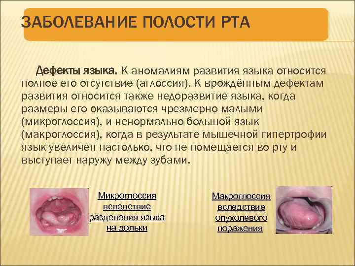 ЗАБОЛЕВАНИЕ ПОЛОСТИ РТА Дефекты языка. К аномалиям развития языка относится полное его отсутствие (аглоссия).