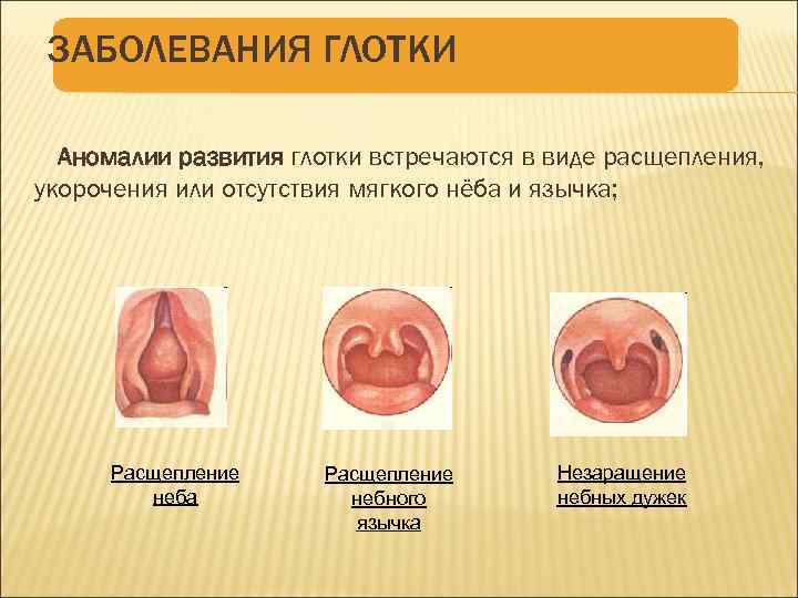 ЗАБОЛЕВАНИЯ ГЛОТКИ Аномалии развития глотки встречаются в виде расщепления, укорочения или отсутствия мягкого нёба