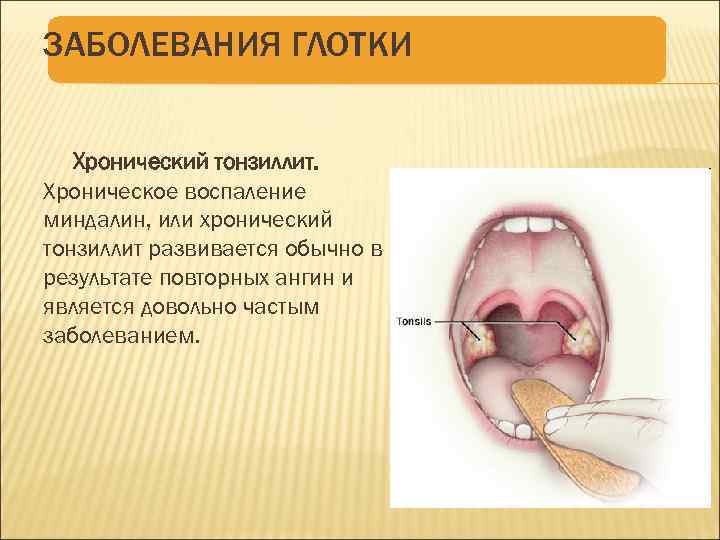 ЗАБОЛЕВАНИЯ ГЛОТКИ Хронический тонзиллит. Хроническое воспаление миндалин, или хронический тонзиллит развивается обычно в результате