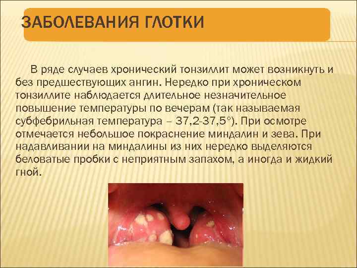ЗАБОЛЕВАНИЯ ГЛОТКИ В ряде случаев хронический тонзиллит может возникнуть и без предшествующих ангин. Нередко