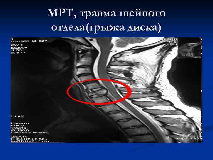 Повреждение шейного отдела позвоночника. Ушиб шейного отдела позвоночника. Последствия травмы шейного отдела позвоночника. Повреждения шейного отдела позвоночника осложнения.