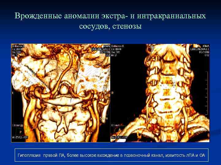 Врожденные аномалии экстра- и интракраниальных сосудов, стенозы Гипоплазия правой ПА, более высокое вхождение в