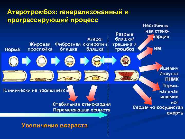 Атеротромбоз: генерализованный и прогрессирующий процесс Норма Атеро. Жировая Фиброзная склеротич бляшка прослойка бляшка Клинически