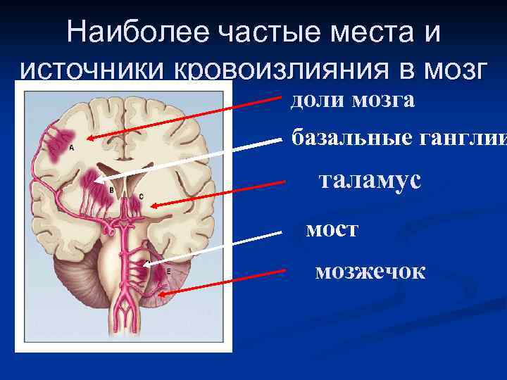 Наиболее частые места и источники кровоизлияния в мозг доли мозга базальные ганглии таламус мост