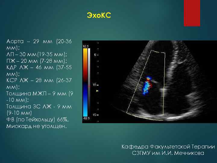 Эхо. КС Аорта – 29 мм (20 36 мм); ЛП – 30 мм(19 35