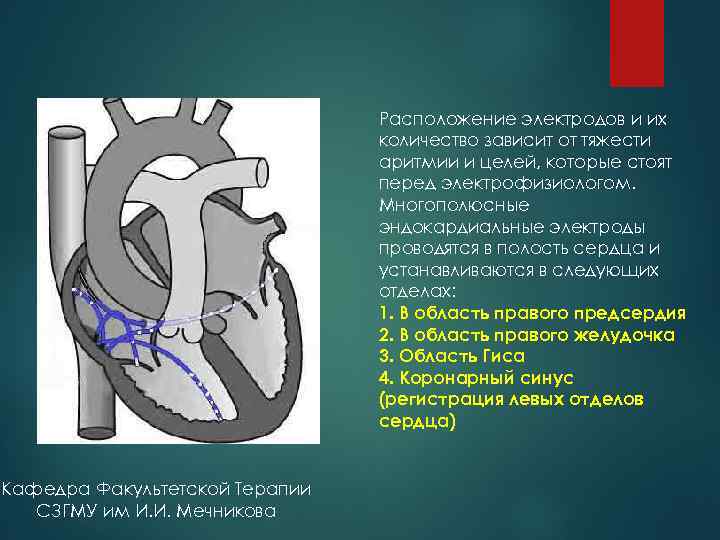 Расположение электродов и их количество зависит от тяжести аритмии и целей, которые стоят перед