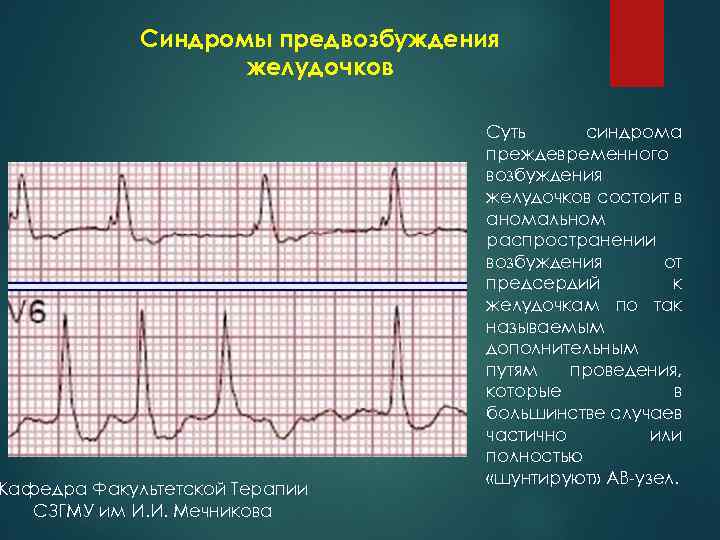 Синдромы предвозбуждения желудочков Кафедра Факультетской Терапии СЗГМУ им И. И. Мечникова Суть синдрома преждевременного