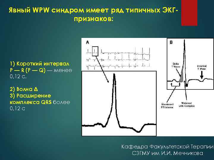 Явный WPW синдром имеет ряд типичных ЭКГпризнаков: 1) Короткий интервал P — R (P