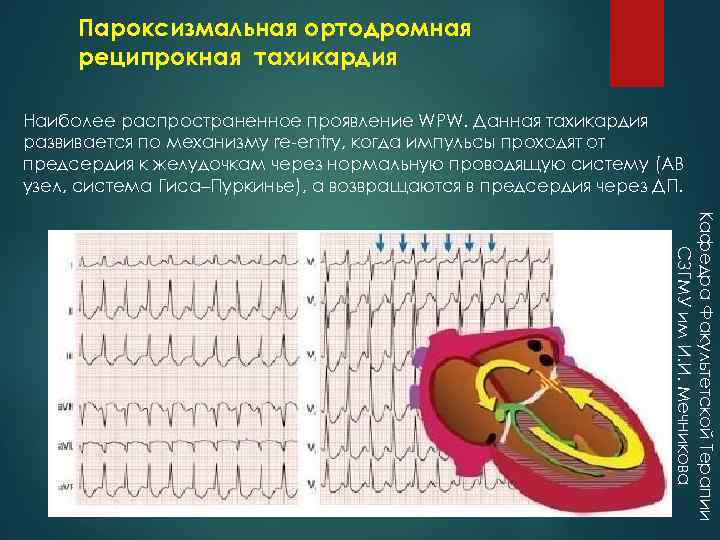 Пароксизмальная ортодромная реципрокная тахикардия Наиболее распространенное проявление WPW. Данная тахикардия развивается по механизму re