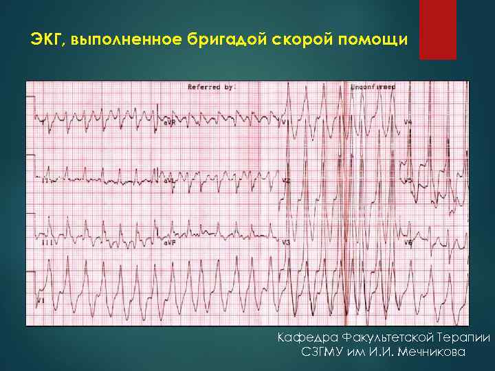 ЭКГ, выполненное бригадой скорой помощи Кафедра Факультетской Терапии СЗГМУ им И. И. Мечникова 