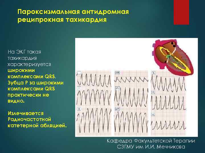 Пароксизмальная антидромная реципрокная тахикардия На ЭКГ такая тахикардия характеризуется широкими комплексами QRS. Зубца Р