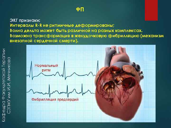 ФП Кафедра Факультетской Терапии СЗГМУ им И. И. Мечникова ЭКГ признаки: Интервалы R-R не