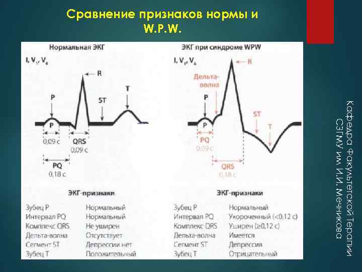 Сравнение признаков нормы и W. P. W. Кафедра Факультетской Терапии СЗГМУ им И. И.