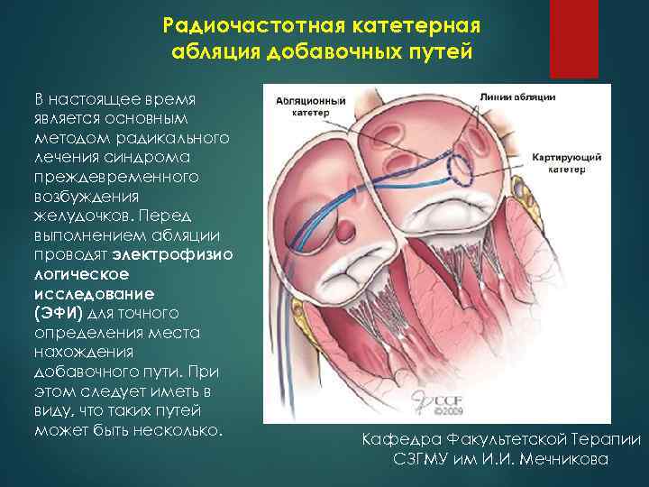 Радиочастотная катетерная абляция добавочных путей В настоящее время является основным методом радикального лечения синдрома