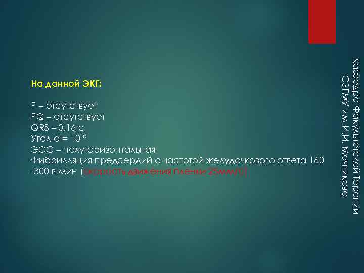 Р – отсутствует РQ – отсутствует QRS – 0, 16 с Угол α =