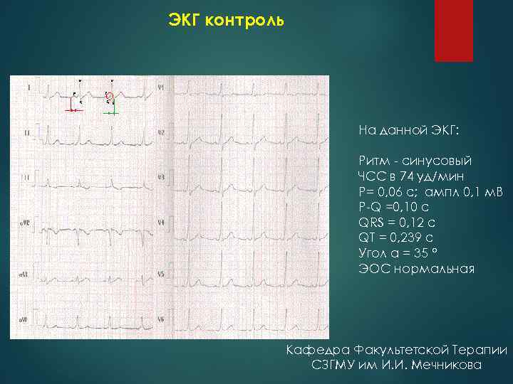 ЭКГ контроль На данной ЭКГ: Ритм синусовый ЧСС в 74 уд/мин Р= 0, 06