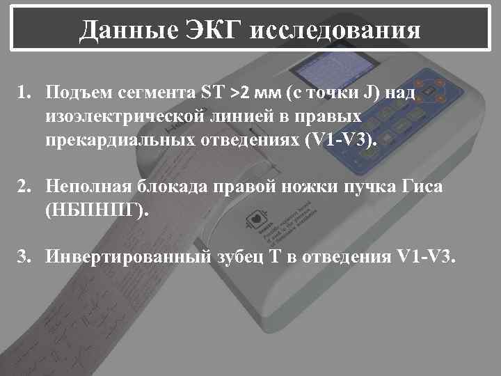 Данные ЭКГ исследования 1. Подъем сегмента ST >2 мм (с точки J) над изоэлектрической