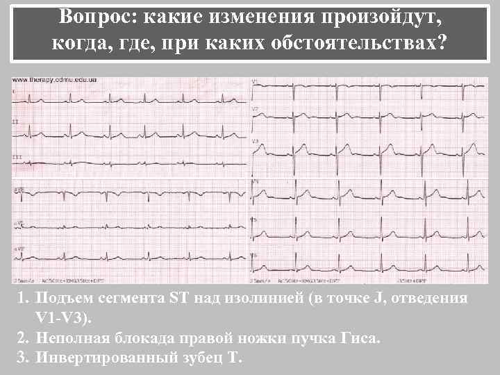 Вопрос: какие изменения произойдут, когда, где, при каких обстоятельствах? 1. Подъем сегмента ST над