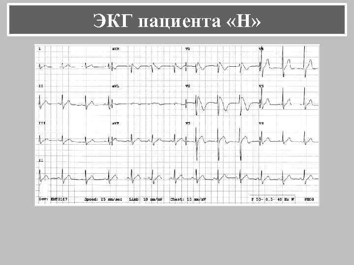 ЭКГ пациента «Н» 