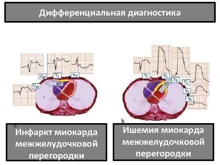 Дифференциальная диагностика Инфаркт миокарда межжелудочковой перегородки Ишемия миокарда межжелудочковой перегородки 