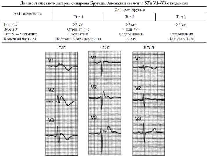 Синдром бругада на экг фото