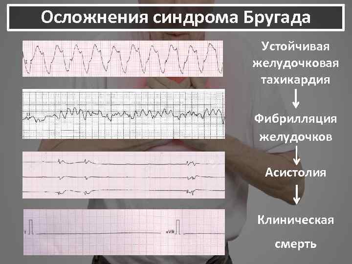 Синдром бругада на экг фото