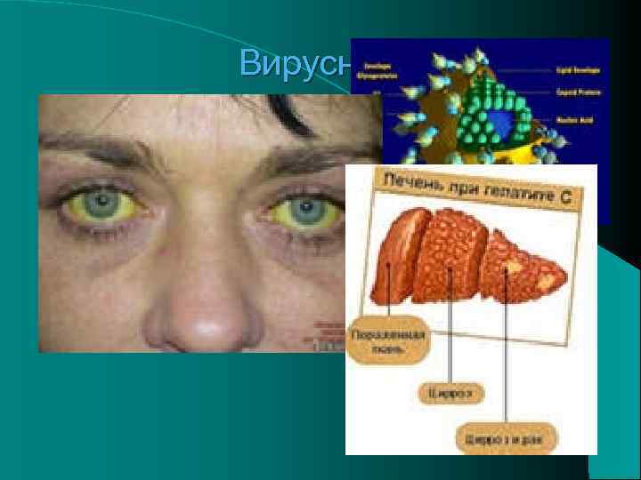 Вирусный гепатит 