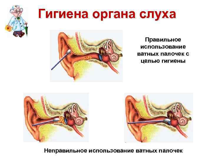 Гигиена органа слуха Правильное использование ватных палочек с целью гигиены Неправильное использование ватных палочек