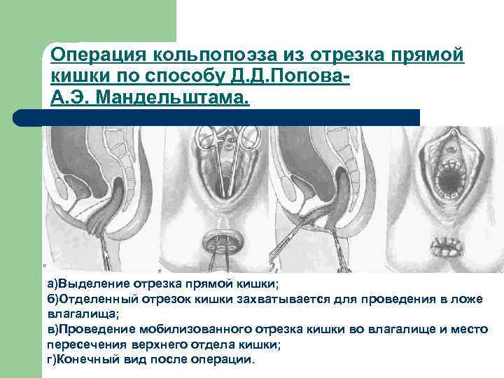 Операция кольпопоэза из отрезка прямой кишки по способу Д. Д. Попова. А. Э. Мандельштама.