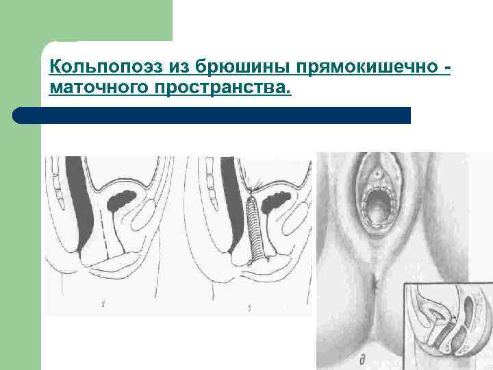 Кольпопоэз из брюшины прямокишечно - маточного пространства. 